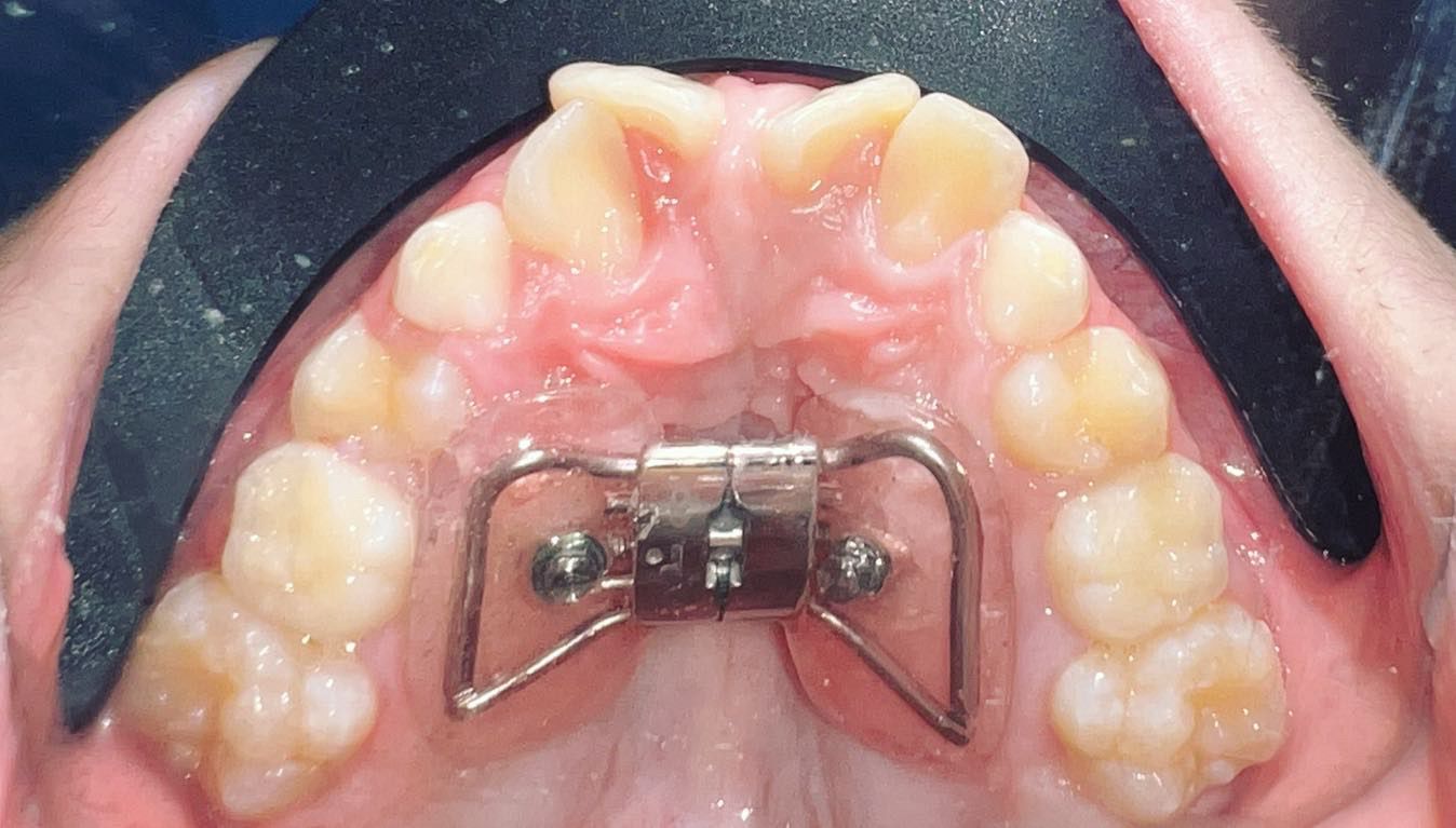 Limpieza dental AIRFLOW en Ales Dental