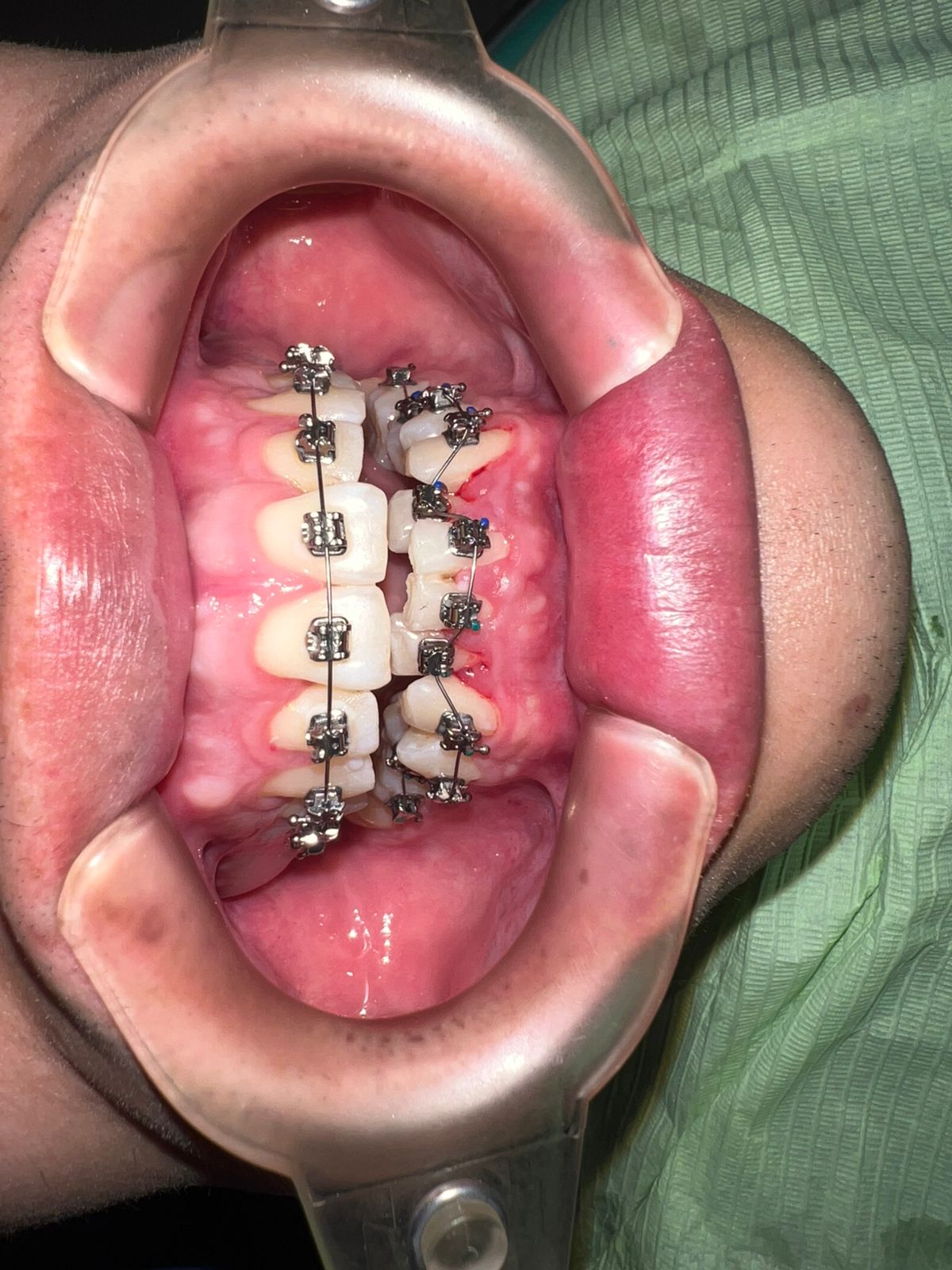 Ortodoncia y alineadores invisibles