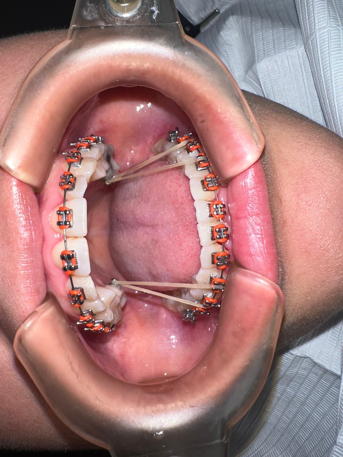 Blanqueamiento dental profesional